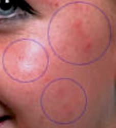 cicatrici acne